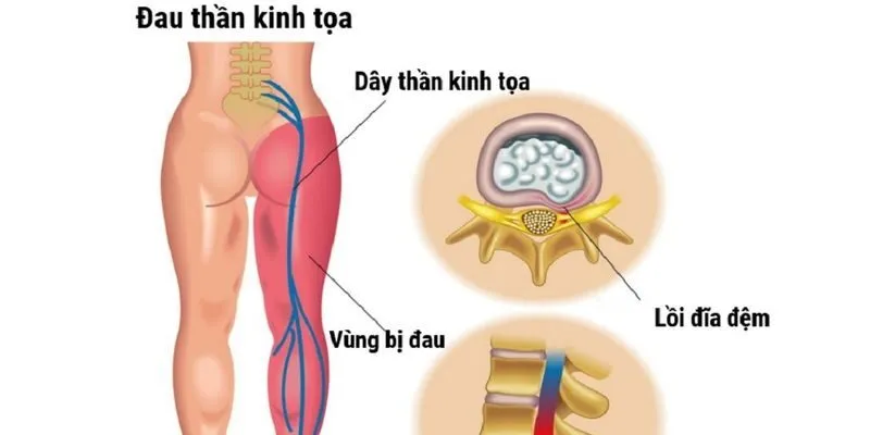 Thoát vị đĩa đệm là một trong những căn bệnh phổ biến ở độ tuổi ngoài trung niên và có thể gây ra các triệu chứng đau lưng và đau dây thần kinh tọa.