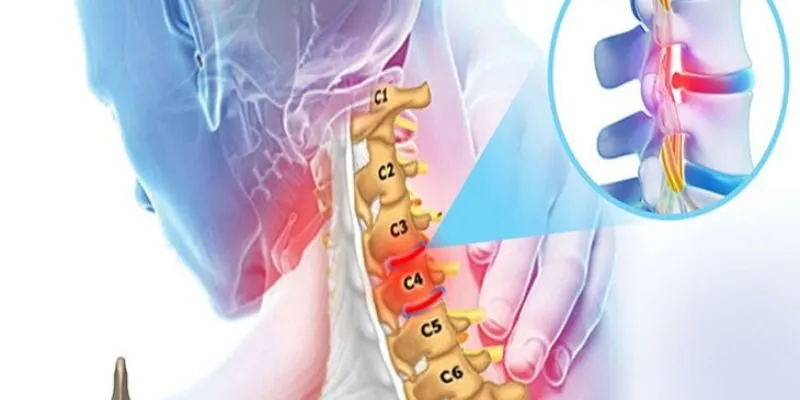 thoát vị đĩa đệm cột sống cổ