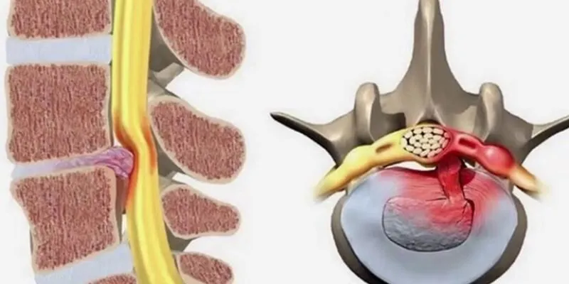 Rách bao xơ, vòng xơ đĩa đệm