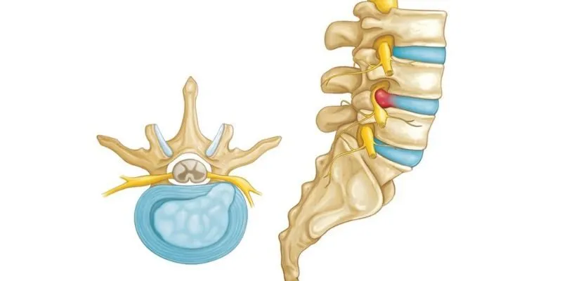 thoát vị đĩa đệm cột sống