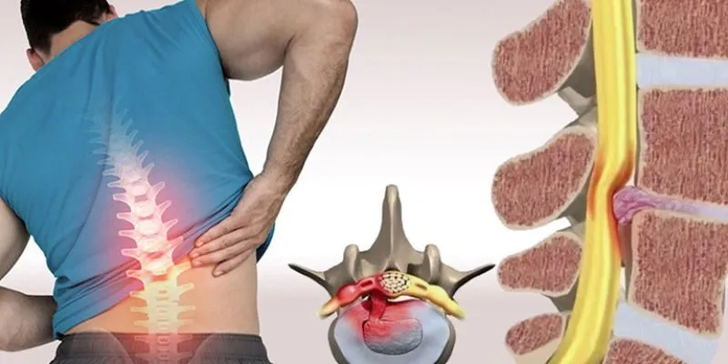 Đĩa đệm, điểm tựa của cột sống