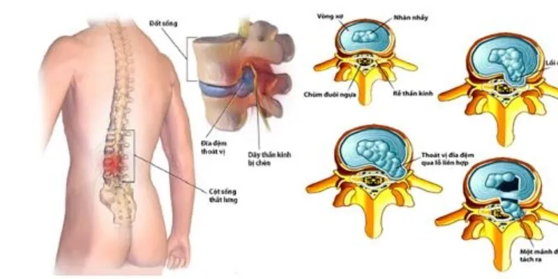 phẫu thuật thoát vị đĩa đệm