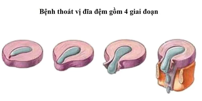 thoát vị đĩa đệm giai đoạn cuối