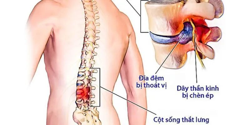 lệch đĩa đệm cột sống
