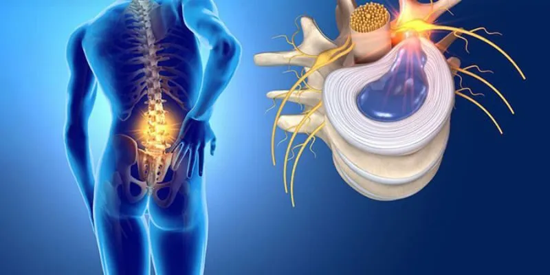 Nguy cơ gây thoát vị đĩa đệm