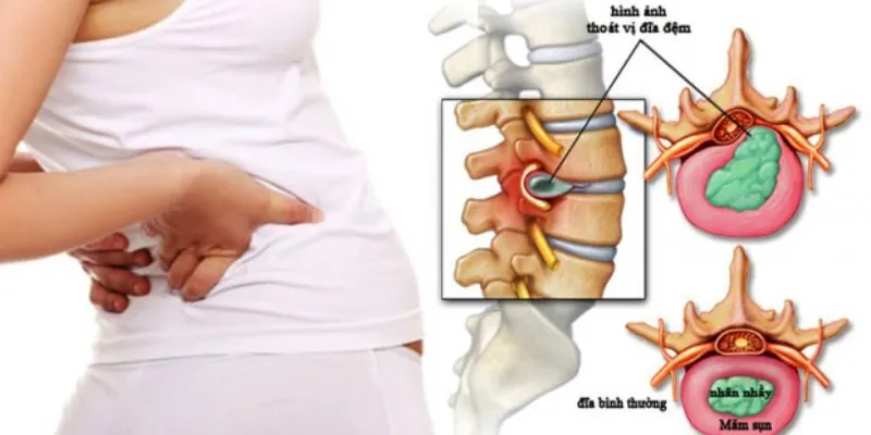 thoát vị đĩa đệm thắt lưng