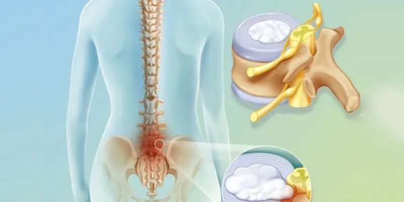 thoát vị đĩa đệm