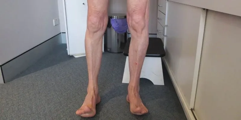 Thoát vị đĩa đệm