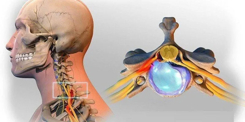 Bệnh thoát vị đĩa đệm cột sống cổ