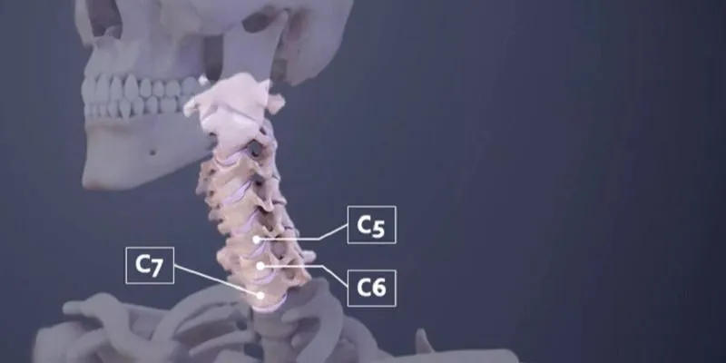 Thoát vị đĩa đệm cột sống cổ C5 C6 C7