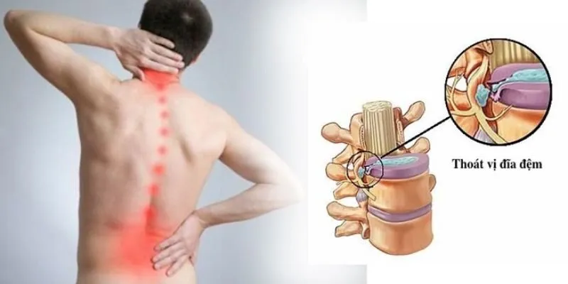 thoát vị đĩa đệm