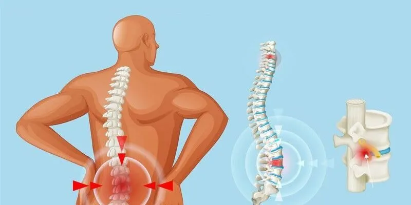 lệch đĩa đệm cột sống