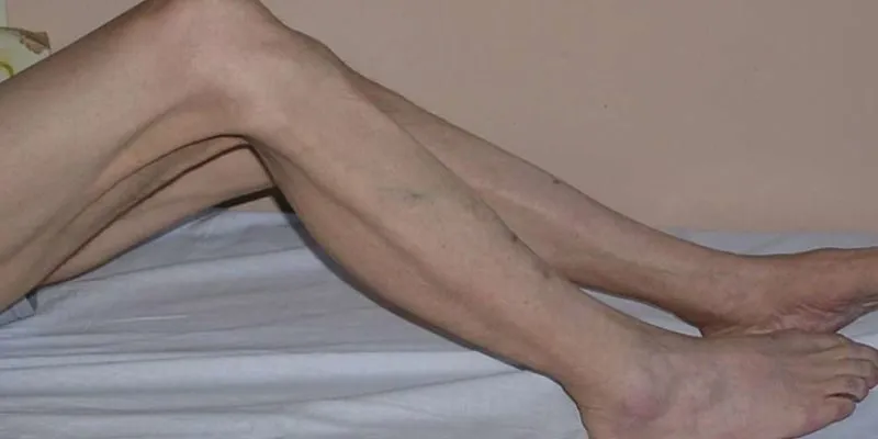 Thoát vị đĩa đệm