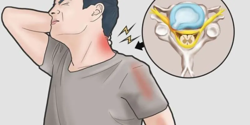 Dấu hiệu thoát vị đĩa đệm