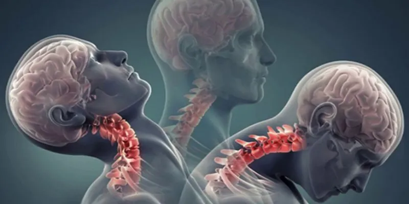 Thoát vị đĩa đệm cột sống cổ C3 C4